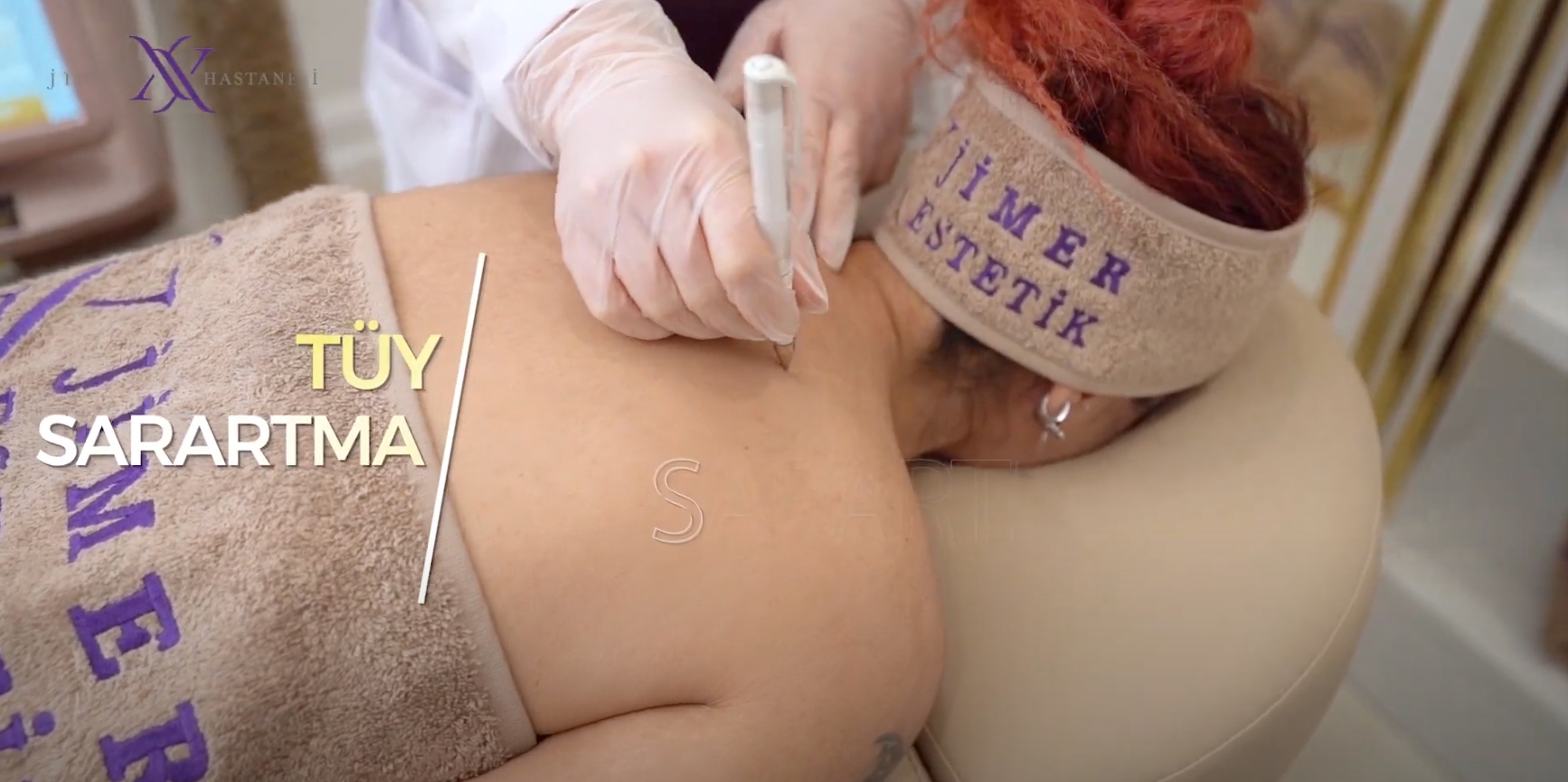 Hair Lightening with Q Switche Laser