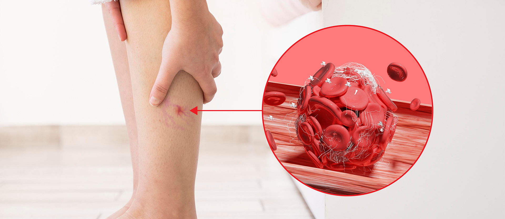 Bursa Varicose Vein Center